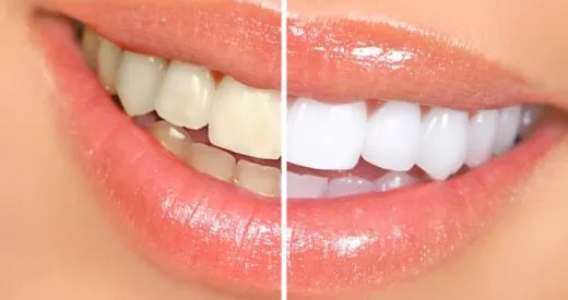Teeth Whitening – Debunking the Myths; Everyone notices a beautiful white smile. Many patients come to us for advice when their teeth become stained.