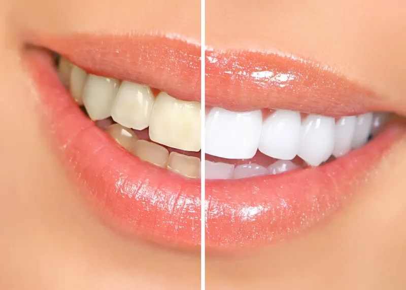 Teeth Whitening – Debunking the Myths; Everyone notices a beautiful white smile. Many patients come to us for advice when their teeth become stained.