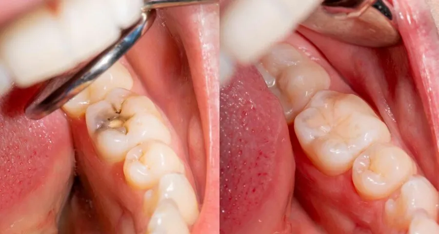 White/Composite Fillings at Dental Care Ireland