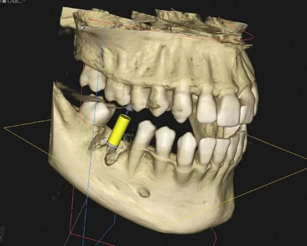 Dental X-Ray