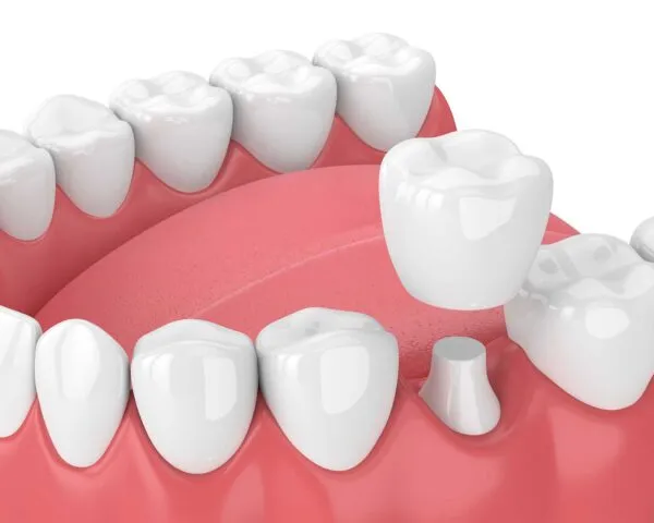 What is a dental crown?