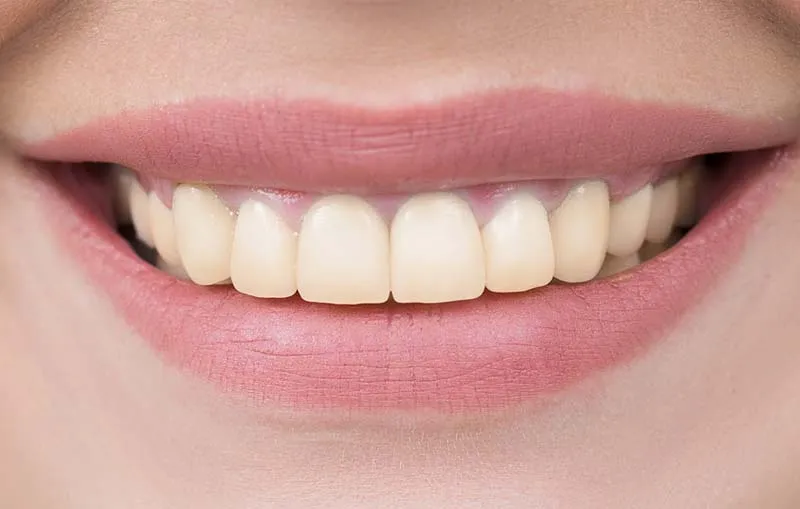 Before/After Teeth Whitening at Dental Care Ireland 1 (before)