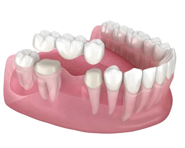 What is a dental bridge?