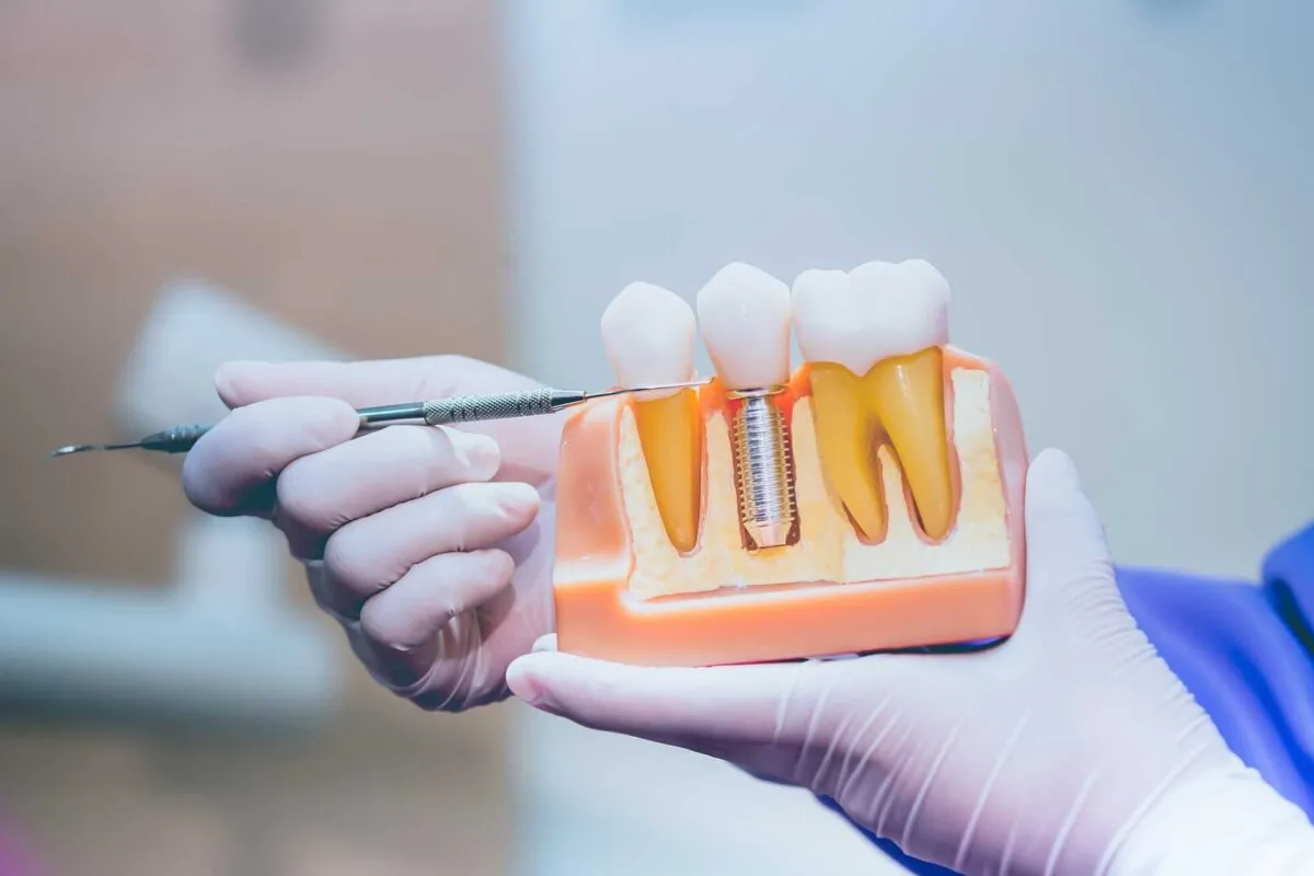 Dental Implants at Dental Care Ireland provide the ultimate solution for missing teeth; a permanent alternative to dentures.