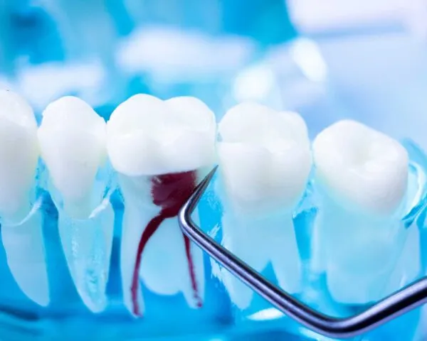 What is root canal treatment? Root canal treatment, also known as endodontics, involves the dentist or endodontist (root canal specialist dentist) opening up the tooth at the crown, removing the infected pulp, cleaning and shaping the canals and filling the canal system.