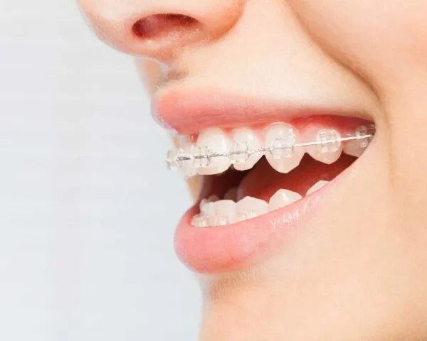 Clear/Ceramic Braces at Dental Care Ireland