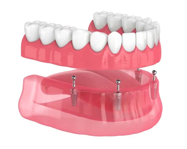 Anchoring Dentures, Dental Implants at Dental Care Ireland
