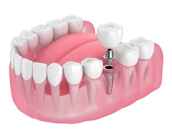 Single Implant Restoration, Dental Implants at Dental Care Ireland