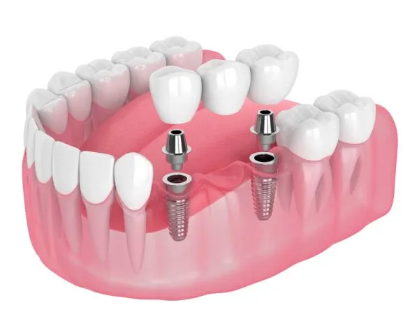Supporting Dental Bridges, Dental Implants at Dental Care Ireland
