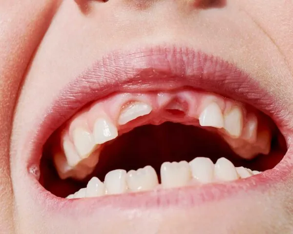 Children’s permanent teeth and Children's Dentistry at Dental Care Ireland.