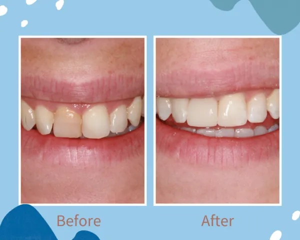 BioClear - Before and After