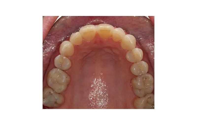 After Invisalign Treatment, Dr Alex Lite, Dental Care Ireland