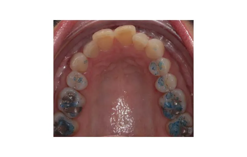 Before Invisalign Treatment, Dr Alex Lite, Dental Care Ireland