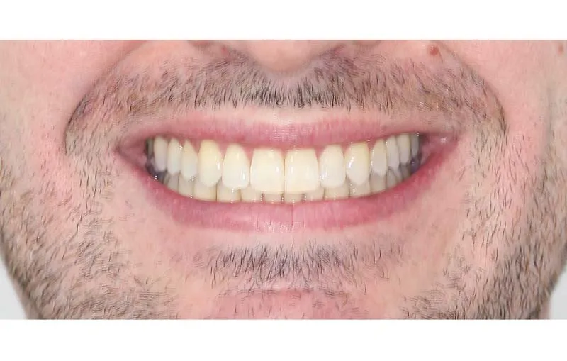 After Invisalign Treatment, Dr Alex Lite, Dental Care Ireland
