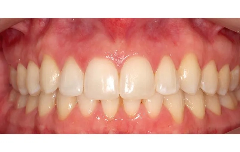 After Invisalign Treatment, Dr Alex Lite, Dental Care Ireland