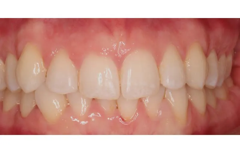 Before Invisalign Treatment, Dr Alex Lite, Dental Care Ireland