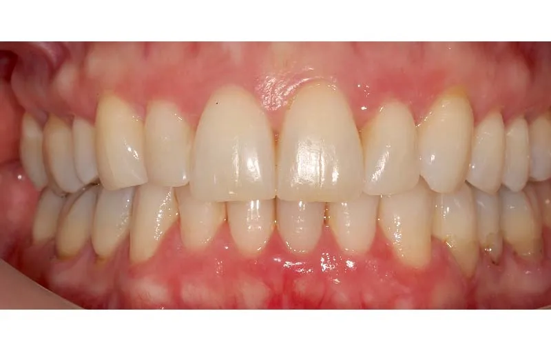 After Invisalign Treatment, Dr Alex Lite, Dental Care Ireland
