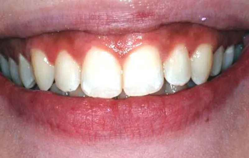 Before/After Invisalign at Dental Care Ireland 2 (after)