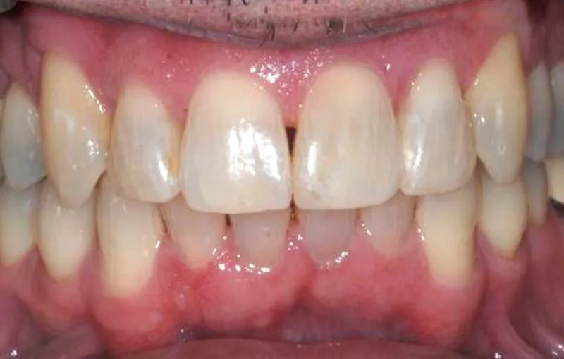 Before/After Invisalign at Dental Care Ireland 4 (after)