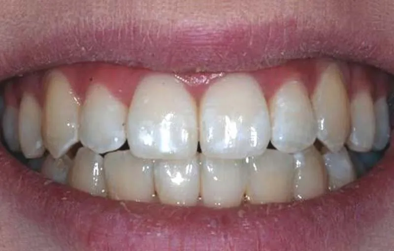 Before/After Invisalign at Dental Care Ireland 5 (after)