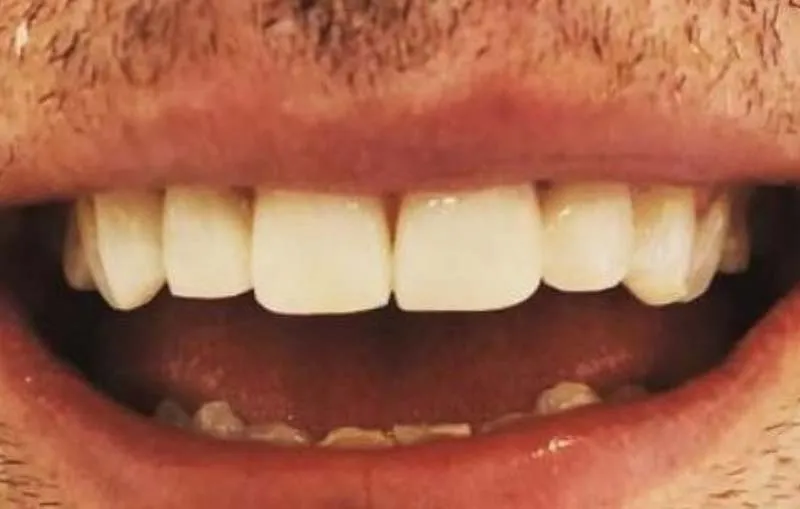 Before/After Composite Bonding at Dental Care Ireland 1 (after)