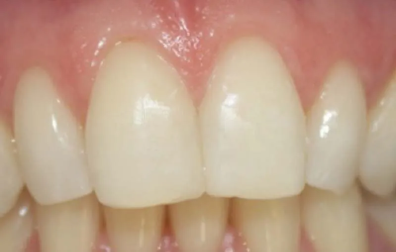 Before/After Composite Bonding at Dental Care Ireland 2 (after)