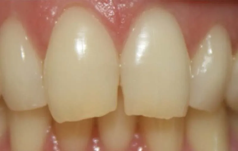 Before/After Composite Bonding at Dental Care Ireland 2 (before)