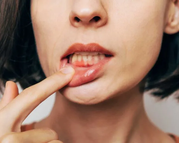 Gum Treatment at Dental Care Ireland