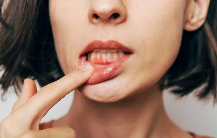 Gum Treatment at Dental Care Ireland