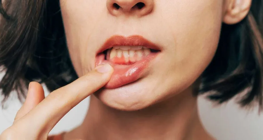 Gum Treatment at Dental Care Ireland