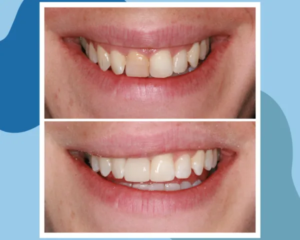 BioClear Before and After 5