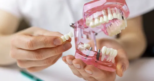 dental implants