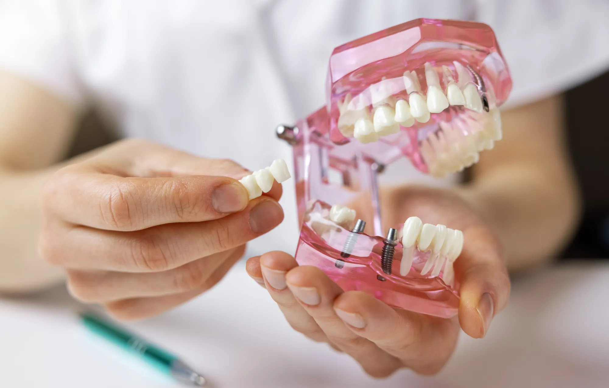 dental implants