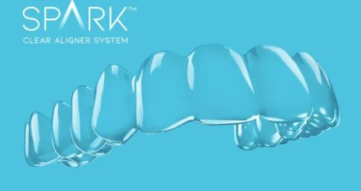 Picture of a Clear Aligner by Spark