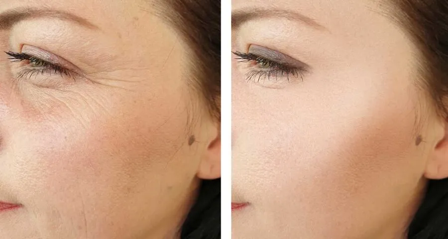Dental Care Ireland, Anti-Wrinkle Before & After